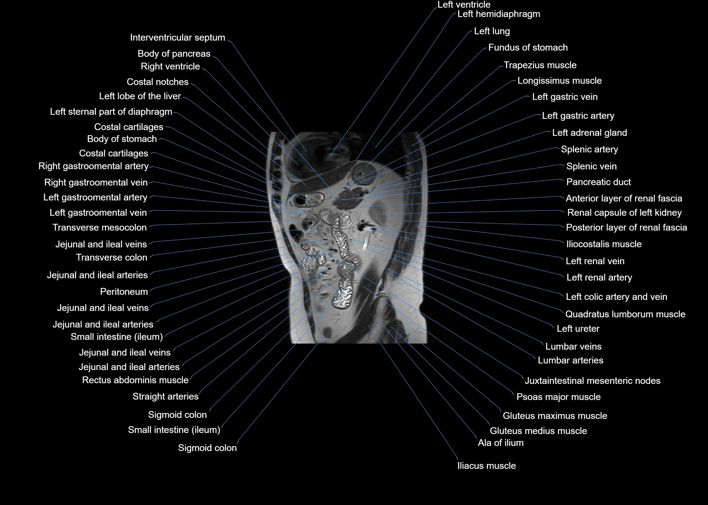 MRI abdomen sagittal cross sectional anatomy  radiology  image-img-00001-00046.webp